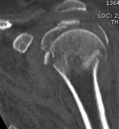 Surgical Neck of Humerus CT 4 Part Coronal